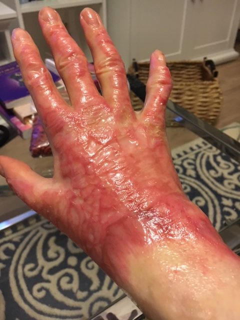 proces gojenia się skóry na rękach