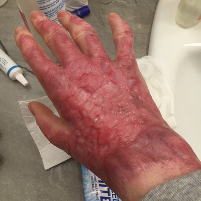 proces gojenia się skóry na rękach